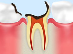 神経に達した虫歯